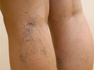 Varices sur les jambes. 